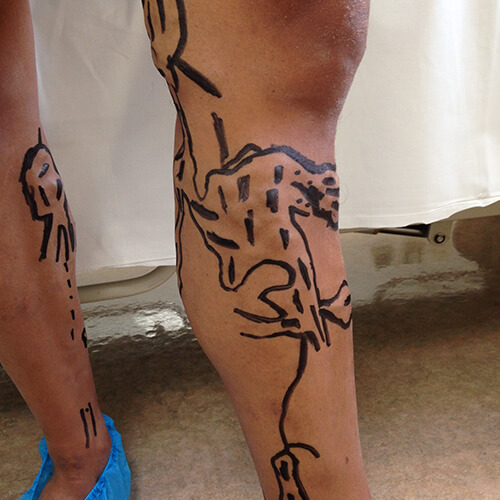 Varicose veins 2