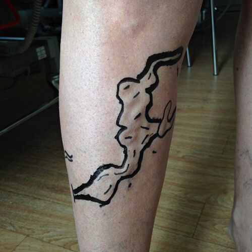 Varicose veins 3