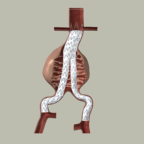 Ενδαγγειακή αντιμετώπιση του ανευρύσματος της κοιλιακής αορτής
