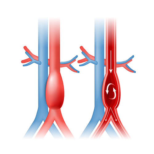 Τι είναι το Ανεύρυσμα κοιλιακής αορτής