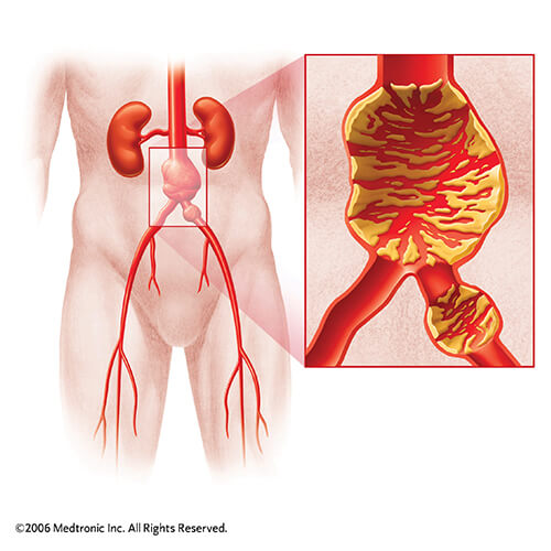 Ανεύρυσμα Κοιλιακής Αορτής